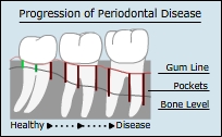 Progression of Periodontal Disease